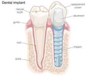 Implant Diagram